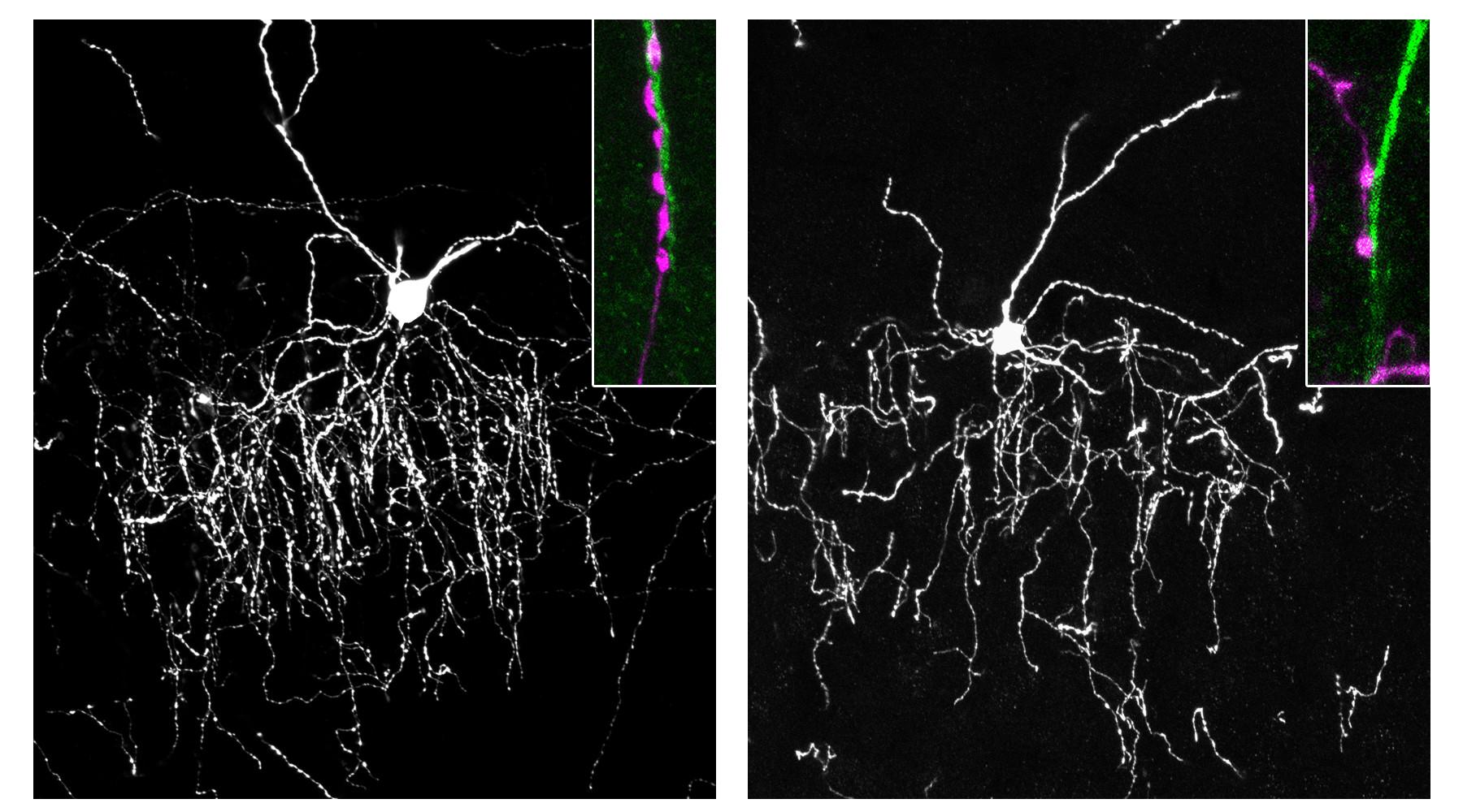 Visualizations of cells in mouse brains show that under normal conditions (left), the connection between chandelier cells and the axon initial segment (AIS) in pyramidal cells results in the placement of synapses, dyed pink, on the AIS. At right, when genes carrying instructions for the protein gliomedin are deleted, fewer synapses are formed on the AIS — an indication that gliomedin is necessary for the “handshake” between the two cell types.